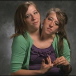 Amazing pics about conjoined twins (1)